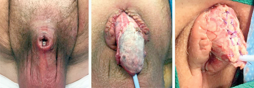 Nach Unfall Beim Oralsex Starb Der Halbe Penis Ab