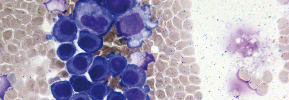 Nachweis einer Meningeosis neoplastica im Liquorsediment: Die Zellen eines Bronchialkarzinoms stellen sich in der Pappenheim-Färbung blau dar.