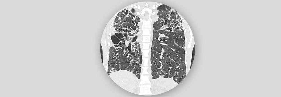 Nicht selten schlägt das variable Immundefektsyndrom auch auf die Lunge.