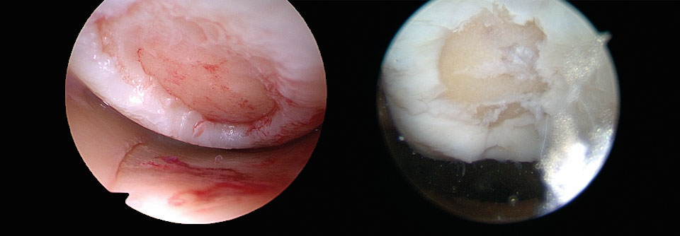 Solche Knorpelschäden wie bei einer 64-Jährigen (links) oder einem 26-Jährigen durch Kollision des Knies mit einem Surfbrett (rechts) lassen sich auch mit einem kleineren Eingriff beheben.
