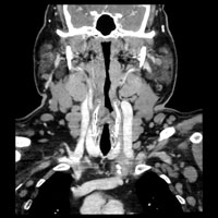 Ein typisches Bild bei CLL: Viele Lymphknoten in Hals und Axilla sind vergrößert.