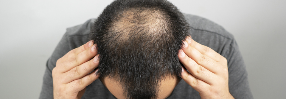 Vor allem Männer leiden bereits in jungem Alter unter starkem Haarausfall.