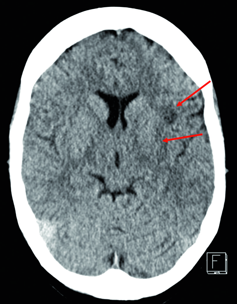 Schlaganfall mit 36 Jahren: Die native Schädel-CT zeigt bei der jungen Frau eine beginnende Infarktdemarkierung in der anterioren Insula (s. Pfeile)