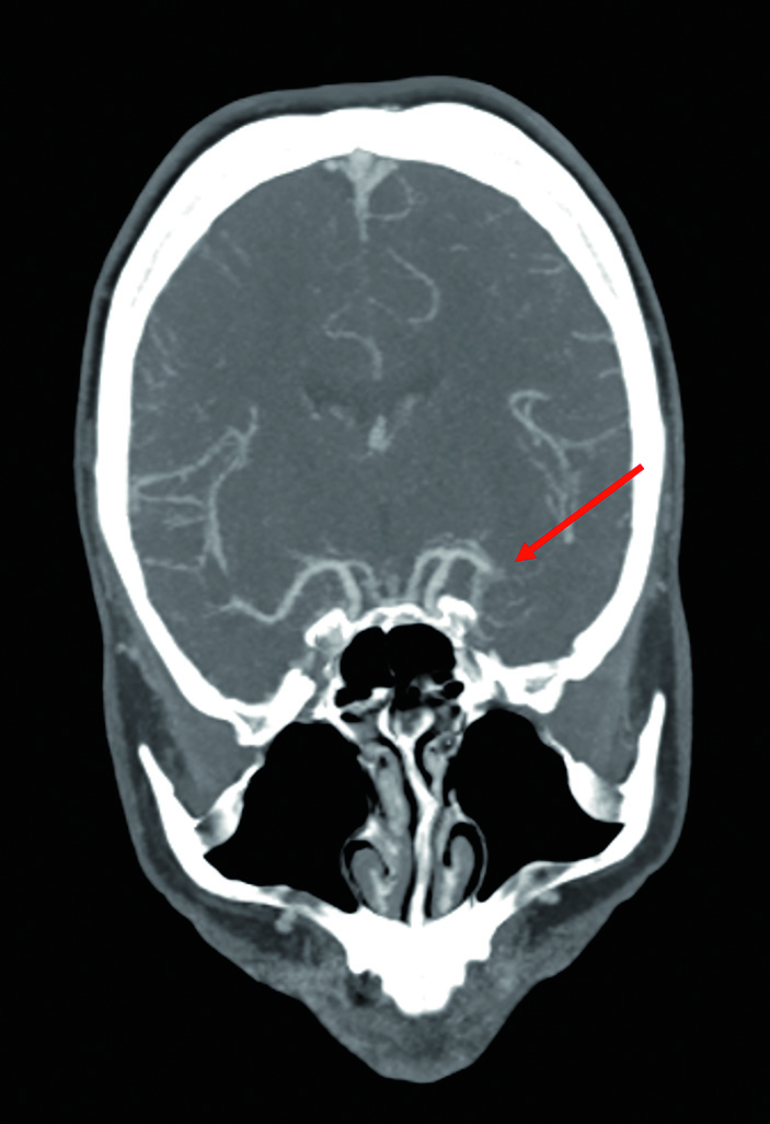 In der CT-Angiographie stellt sich ein Abbruch der linken A. cerebri media dar. 