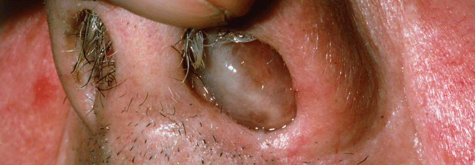 Die Polyposis nasi gehört zu den typischen Symptomen einer eosinophilen Granulomatose mit Polyangiitis.