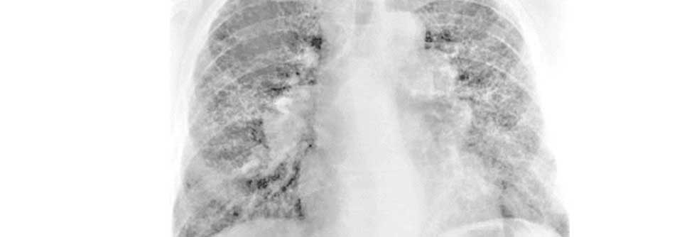 Die Lunge eines 54-jährigen Arbeiters, der eine chronische Beryllliose entwickelt hat.