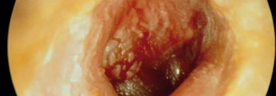 Rezidivierende akute Mittelohrentzündungen im Kindesalter können auf einen IgA-Mangel hinweisen.