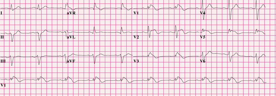 EKG eines Brugada-Syndroms Typ 1. Diese autosomal-dominant vererbte Erkrankung führt zu paroxysmalen ventrikulären Tachykardien bis hin zum Kammerflimmern. Betroffene sterben oft schon früh am plötzlichen Herztod.