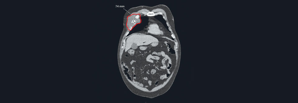 In der präoperativen CT lässt sich erkennen, dass der Tumor bereits die Rippen 4–6 zerstört hat.