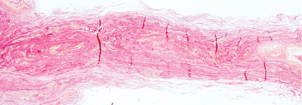 Histopathologisch sieht man beim Morton-Neurom die Fibrose rund um die betroffenen interdigitalen Nerven.