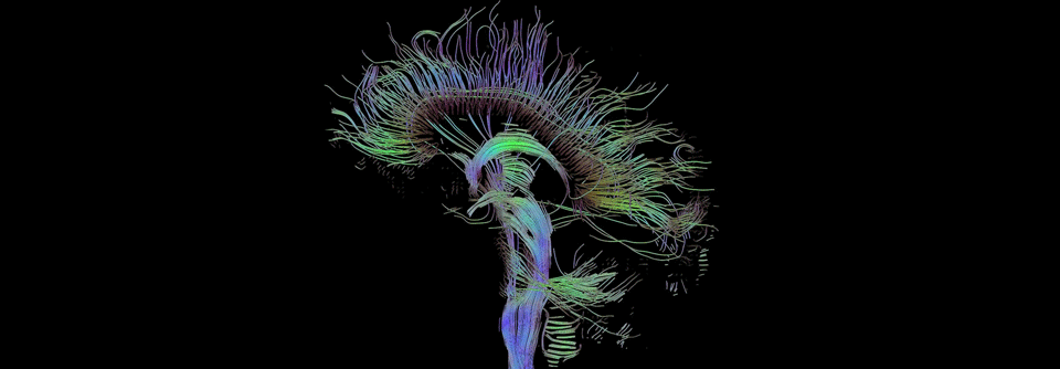Die Diffusions-Tensor-Bildgebung, eine MRT-Technik, visualisiert die mikrostrukturellen Eigenschaften von Hirngewebe. 