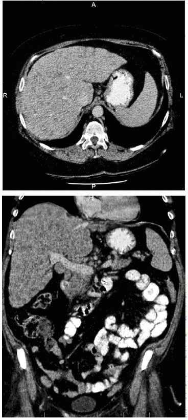 Im CT zeigen sich die vorbeschriebenen Inhomogenitäten in der Leber deutlich, sowie betonte Lymphknoten.
Mit freundlicher Genehmigung: Radiologie Thomas Försterling, Salzgitter