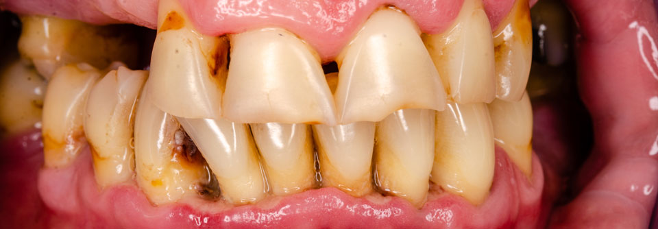 Eine Parodontitis könnte das Risiko für eine ACPA-positive RA erhöhen. 
