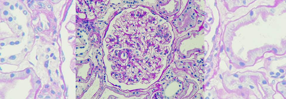 Zur Therapie der  IgA-Nephropathie stehen viele Optionen zur Verfügung.