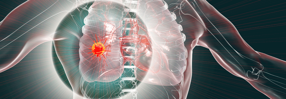 Tislelizumab ist zugelassen für fortgeschrittenes NSCLC und Ösophaguskarzinom.