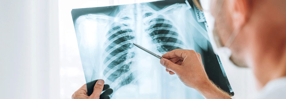 Kinaseinhibitoren wie Alectinib und Osimertinib spielen eine wichtige Rolle bei lokal fortgeschrittenem NSCLC.