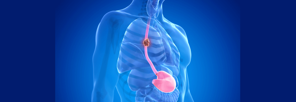 Die FLOT-Chemotherapie zeigt laut Studie einen größeren Nutzen als die Radiochemotherapie beim Ösophaguskarzinom.