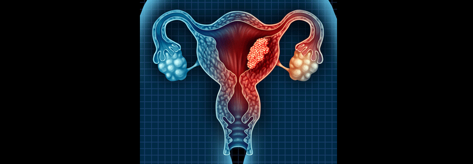 Patientinnen mit fortgeschrittenem Endometriumkarzinom profitieren von kombinierter Immun- und Chemotherapie.