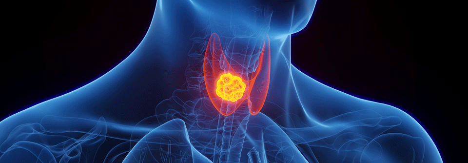 Molekulare Therapien gewinnen bei Schilddrüsenkrebs an Bedeutung.