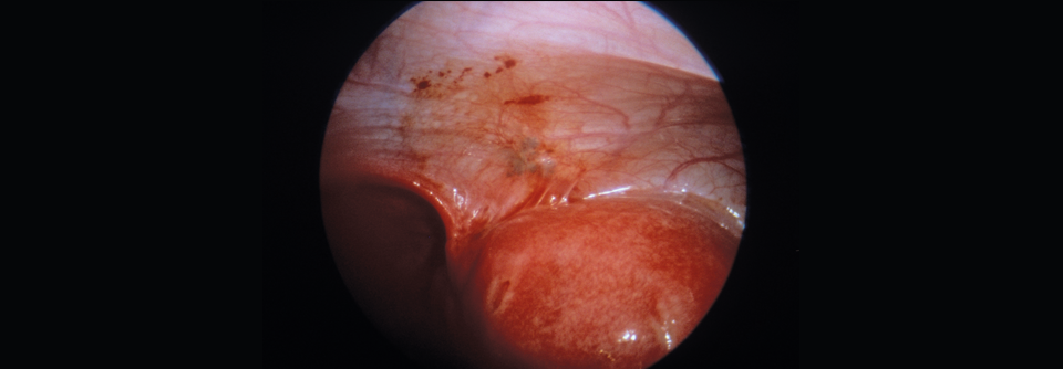 In diesem Fall hat ein Endometrioseherd das Peritoneum befallen. U. a. können auch Darm, Haut oder Gehirn betroffen sein.