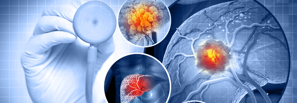 Kombinationstherapien mit Durvalumab zeigen in der Erstlinie deutlich bessere Überlebensraten als Vergleichstherapien.