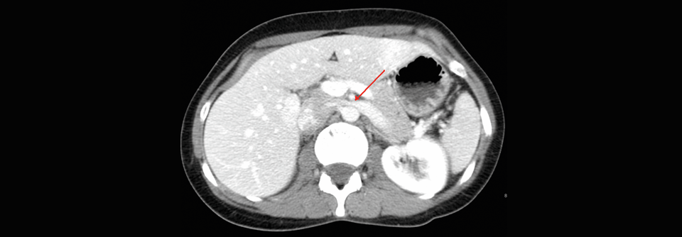 Bei dem beschriebenen Patienten mit Nussknacker-Syndrom war die linke Nierenvene (Pfeil) zwischen Aorta und A. mesenterica komprimiert, ähnlich wie hier abgebildet.