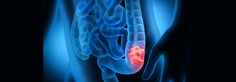 EGFR-Inhibitoren bleiben bei metastasiertem CRC ohne RAS/BRAF-Mutation wichtig, besonders bei linksseitigen Tumoren.