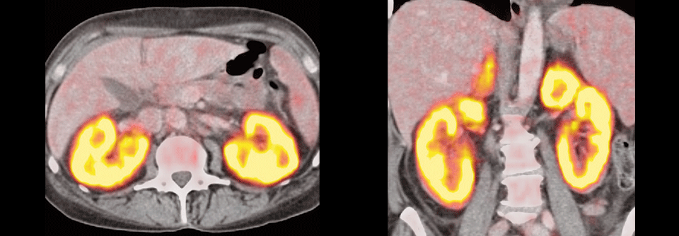 In der PET-CT ist in den Nieren von Katharina von der Leyen eine hohe Stoffwechselaktivität zu erkennen.