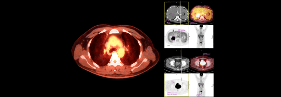 Ein differenziertes Vorgehen könnte die Alzheimerdiagnostik im „Graubereich“ verbessern. Das Prozedere umfasst einen zusätzlichen PET-Scan je nach Liquorbefund.