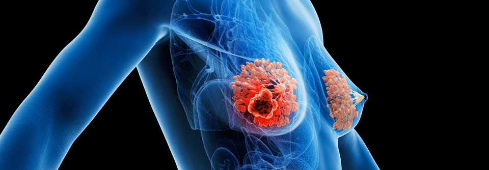 HER2<sup>-</sup> Mammakarzinom: ADC beeinträchtigen die Effektivität nachfolgender Linien Patient:innen mit HER2- MBC profitieren am stärksten vom ersten ADC – spätere Therapien wirken deutlich schlechter.