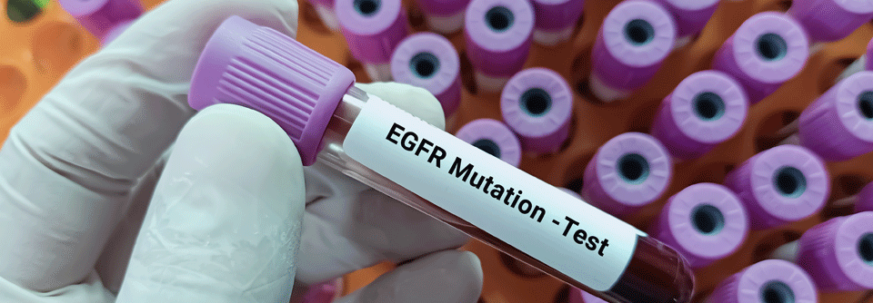 EGFR<sup>+</sup> NSCLC: FLAURA2 vs. MARIPOSA Osimertinib mit Chemotherapie ist Erstlinienstandard beim EGFR+ NSCLC, doch der Vergleich zu MARIPOSA bleibt offen.