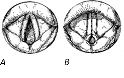 Abb. 1: Die Zeichnung zeigt das Aussehen der Stimmbänder bei der Einatmung (A) eines gesunden Menschen und (B) bei einem Patienten mit VCD. Man kann gut den paradoxen Verschluss der Stimmbänder (B) erkennen. Charakteristisch ist die mit einem Kreis gekennzeichnete, diamantförmige Spalte. (Quelle: Mayo Foundation)