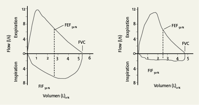 Abb. 2: Typische Abflachung der Inspirationskurve durch Flusserniedrigung bei VCD  in der Spirometrie: FIF 50 % (=MIF 50 %)  <  FEF 50 % (=MEF 50 %) 