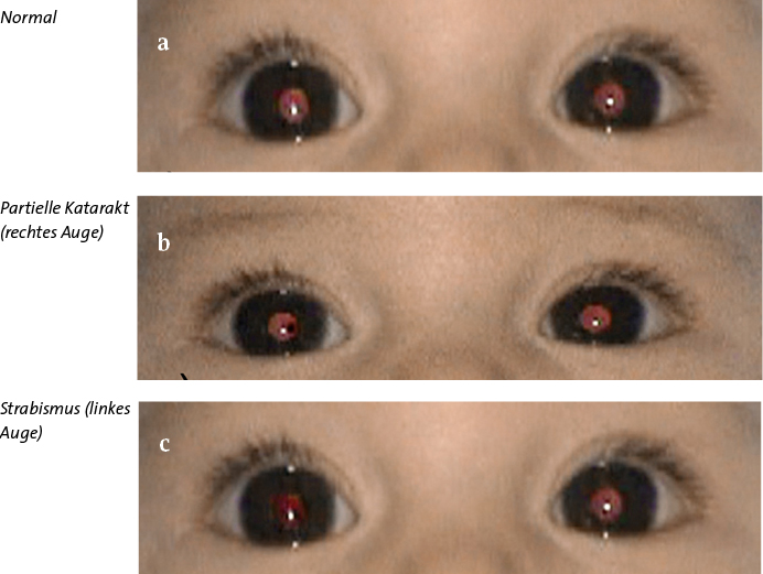 Abb.1: physiologisch ist a) ein helles Leuchten beider Pupillen, pathologisch ist b) ein partieller oder totaler Schatten eines Auges (z.B. Katarakt);c) seitendifferentes Leuchten beim Strabismus, hier des linken Auges