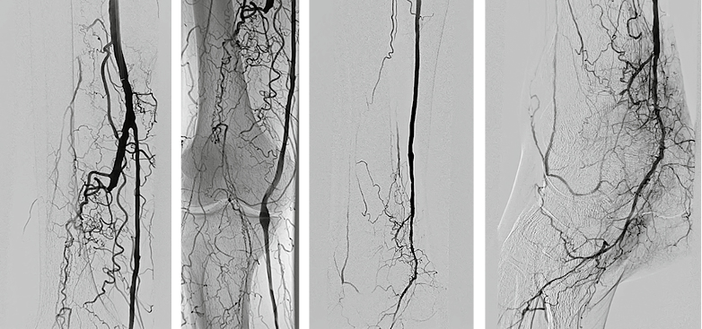 Abb. 1: Pedaler Bypass von der A. femoralis superficialis auf die A. tibialis posterior