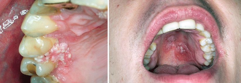 Bei diesem HIV-positiven Patienten haben
sich Kondylome mit Nachweis von humanen Papillomviren Typ 6 im Mund gruppiert.