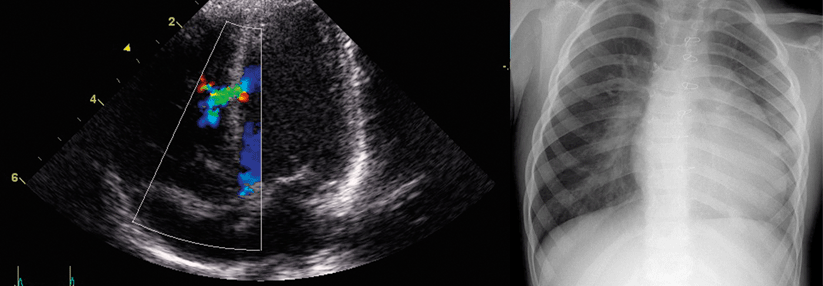 Häufigster angeborener Herzfehler ist der Ventrikelseptumdefekt (links). Bei der Fallot-Tetralogie kommt es zu einer Rechtsherzhypertrophie (rechts).