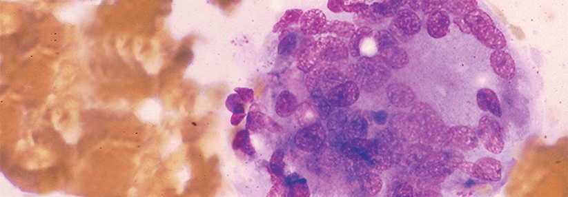Riesenzellen prägen das histologische Bild einer subkutanen Thyreoiditis - in diesem Fall nach einer Feinnadelaspiration.