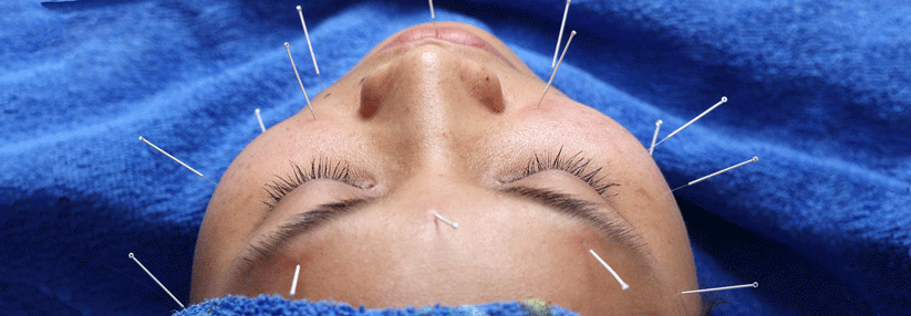 In China wird die Akupunktur auch zur Migräneprophylaxe angewendet.