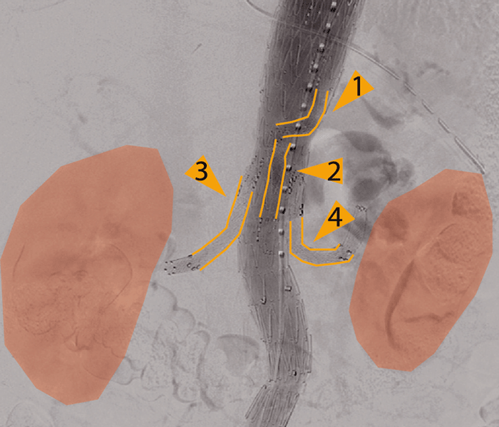 Dieses thorakoabdominelle Aortenaneurysmas wurde mit einem Stent ausgeschaltet, hier erkennt man das Nierenparenchym  (orange) – zum Anschluss an Truncus coeliacus (1), Arteria mesenterica superior (2) und beide Nierenarterien (3,4).