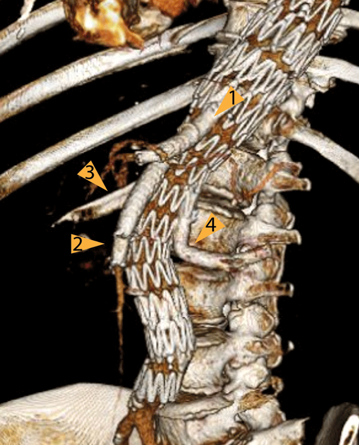 Dieses thorakoabdominelle Aortenaneurysmas wurde mit einem Stent ausgeschaltet, hier erkennt man den Stent mit vier Seitenarmen – zum Anschluss an Truncus coeliacus (1), Arteria mesenterica superior (2) und beide Nierenarterien (3,4).