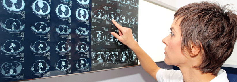 Computertomographie oder Lungenszintigraphie bei Verdacht auf Lungenembolie? 