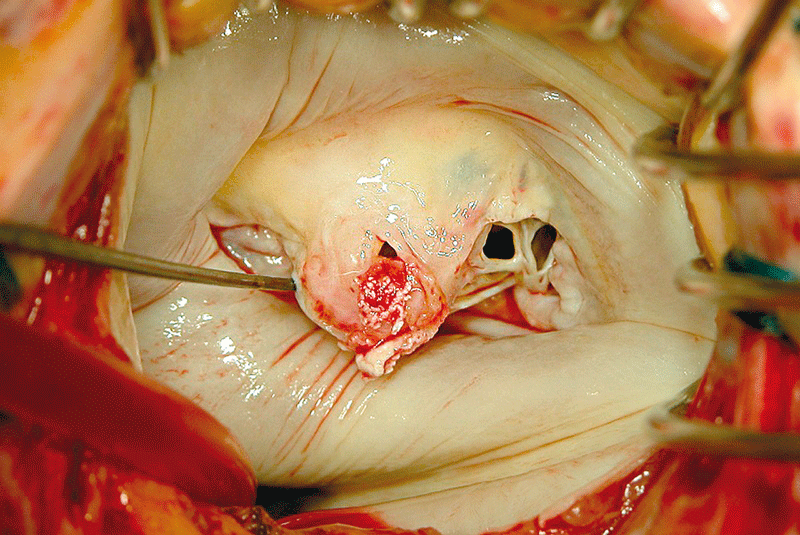 Nach der lokalen Infektsanierung implantierten die Operateure diese biologische Aortenklappe minimalinvasiv. 