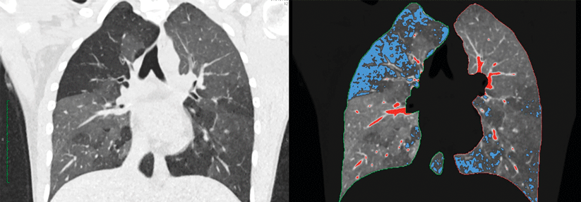 CT bei Verdacht auf COPD (links) und darübergelegtes qCT (rechts).  Blau: Areale mit gefangener Luft, rot: Gefäße.