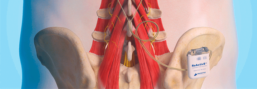 An den Querfortsätzen der LWS fixiert, stimulieren die Elektroden den Ramus dorsalis der Spinalnerven. 
