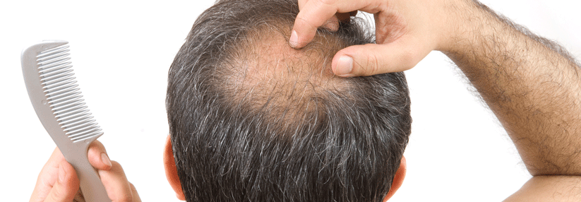 Finasterid wird unter anderem bei Alopezie eingesetzt.