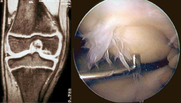Bei der Osteochondrosis dissecans ermöglicht die MRT (links) die exakte Lokalisation, Verlaufskontrolle und Einschätzung der Vitalität. Eine genauere Beurteilung gelingt mittels Arthroskopie (rechts).