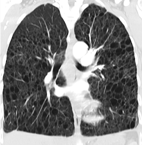 In der Lunge dieser Patientin mit Lymphangioleiomyomatose sind zahlreiche dünnwandige Zysten erkennbar.