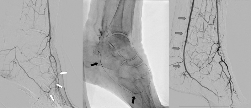 Mit einer retrograden Technik gelang es bei einer 92-Jährigen mit nicht heilendem Fersenulkus die Arteria tibialis posterior zu rekanalisieren.