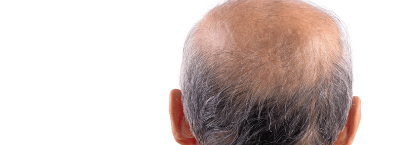 Beim androgenetischen Haarausfall bleibt der Hinterkopf ausgespart.